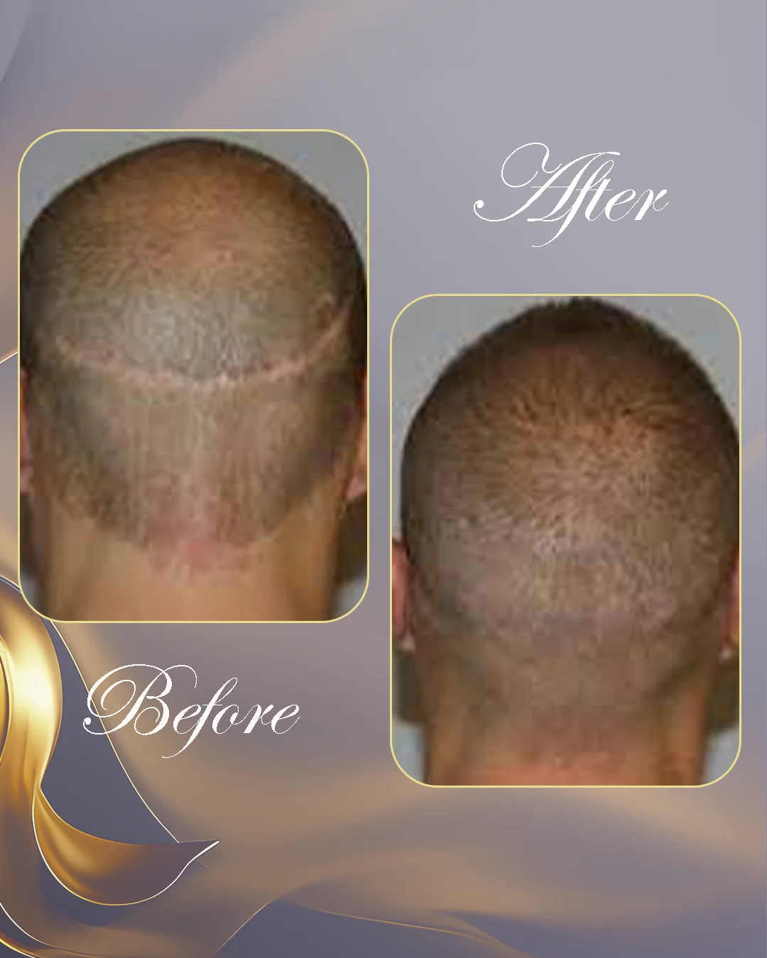 زراعة الشعر في تركيا