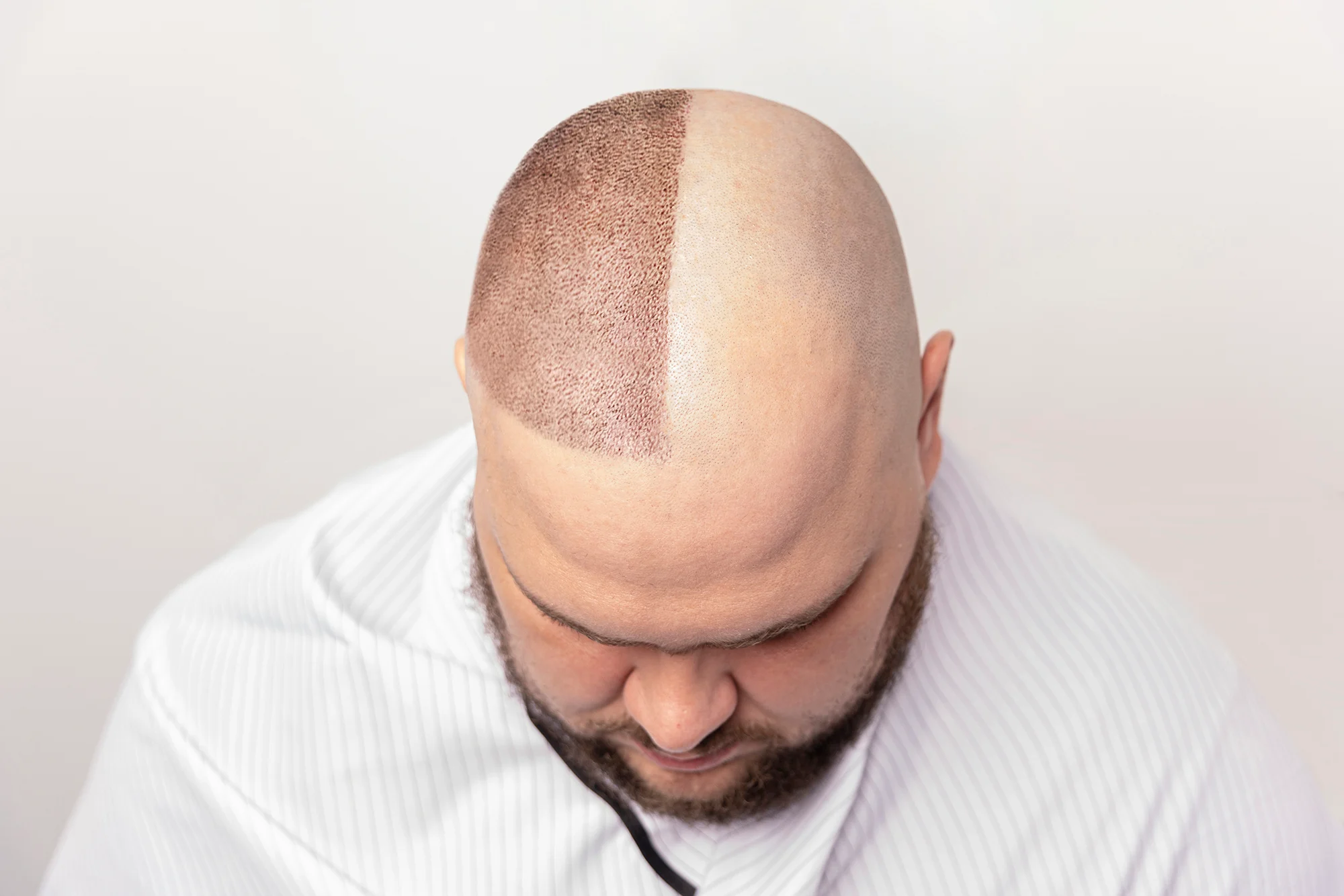 Hair Transplant