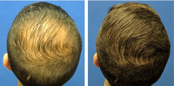 زراعة الشعر